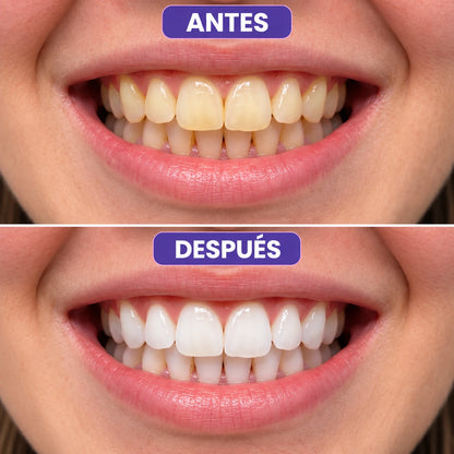 Hismile Blanco Mágico™ | Tiras Moradas Blanqueadoras