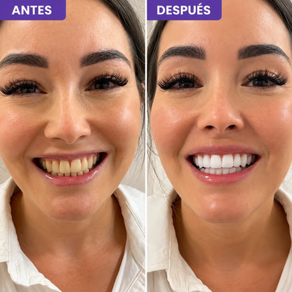 Hismile Blanco Mágico™ | Tiras Moradas Blanqueadoras
